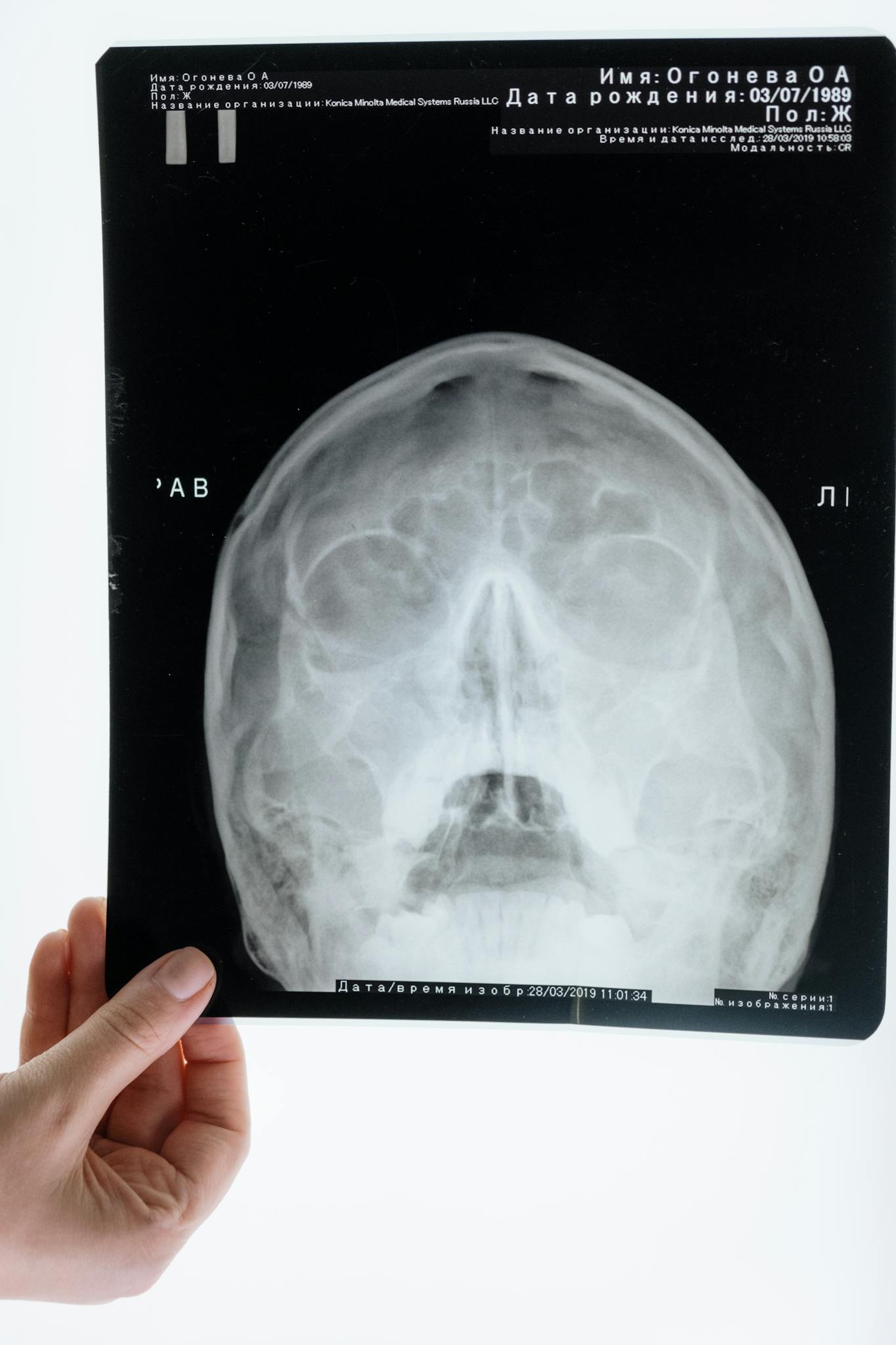 Detailed X-ray image of a human skull, showcasing medical examination through radiography.